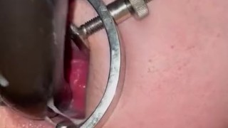 my new speculum opens my hungry ass! this long dildo made my prolapse fart